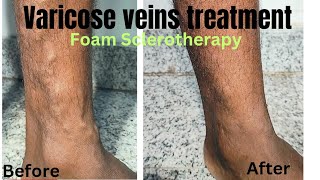 Foam sclerotherapy treatment for varicose veins Miracle of varicose veins treatment varicosevein [upl. by Bernete859]