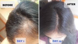 OMG  15 Days Hair Growth Miracle Treatment  Grow Long Thicken Hair  100 works [upl. by Acenahs529]