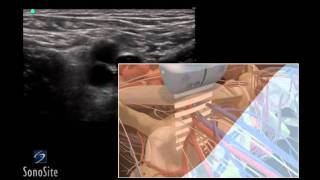 How To Ultrasound Guided Insertion of a Femoral Vein Catheter 3D Video [upl. by Eahsal191]