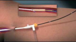 Animation of Endovenous Radiofrequency Ablation of Varicose Vein [upl. by Hodgkinson]