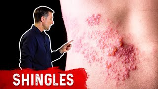 Shingles Natural Relief [upl. by Eirrab]