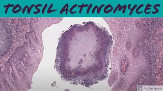 Tonsil Actinomyces 5Minute Pathology Pearls [upl. by Ahcsim]