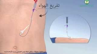 Gastrostomy Feeding Tube أنبوب التغذية ميكي عبر جدار البطن [upl. by Richmal]