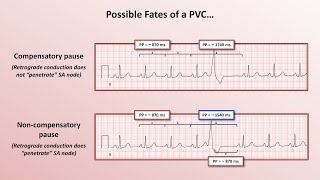 Advanced EKGs  PACs and PVCs ie premature beats [upl. by Tess710]