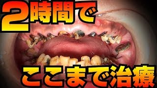 重度虫歯２時間でここまで治療dentistry歯医者2小時內就能完成這些治療 [upl. by Nitsir782]