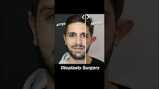 Otoplasty Surgery earsurgery [upl. by Florin851]