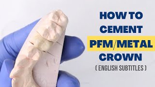 How to Cement a PFMMetal Crown [upl. by Ened]