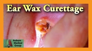 Ear Wax Removal of a Full Ear  Auburn Medical Group [upl. by Lerim]