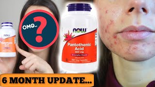 I TOOK PANTOTHENIC ACID FOR 6 MONTHS HERE IS THE UPDATE  Did B5 get rid of cystic acne fast [upl. by Sosanna588]