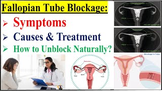 Fallopian Tube Blockage Symptoms Causes Diagnosis amp TreatmentHow To Open Blocked Fallopian Tubes [upl. by Pacificia]