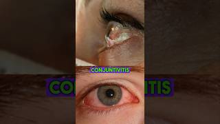 Tratamiento para la Conjuntivitis conjuntivitis tratamiento antibioticos bacteria ojos minsa [upl. by Eeznyl]