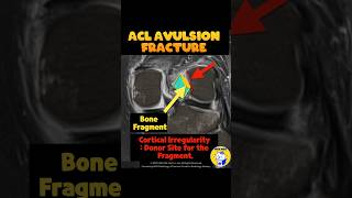 Fig 2B15 ACL Avulsion fracture from the femoral attachment [upl. by Remliw]