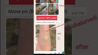 Lipoma 100  cured in ayurveda viral [upl. by Asikal]