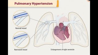 Pulmonary Hypertension ESC guidelines 2022 part 1A [upl. by Naanac526]