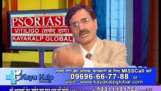 Use of Babchi in VitiligoLeucoderma Treatment In India by Ayurveda Kayakalp Global [upl. by Idihsar]