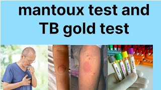 Mantoux test hindi main TB gold test hindi mainTB disease investigation [upl. by Annirok296]