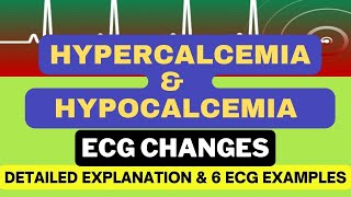 Hypercalcemia and Hypocalcemia ECG changes with 6 Examples Mechanism and Detailed Explanation [upl. by Ahsiyk]