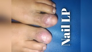 IL TRICORT FOR NAIL LICHEN PLANUS [upl. by Maynard]