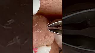 Skincare  Blackheads Removal 145 skincare skincare blackheads blackheads [upl. by Theis]