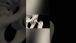 Total Hip Replacement medicalanimation health shorts [upl. by Elicec]