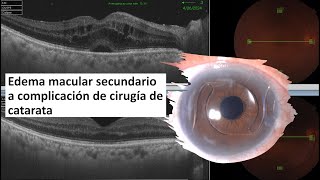 Edema macular secundario a cirugía de catarata complicada tratado con vitrectomía  IrvineGass [upl. by Beasley]