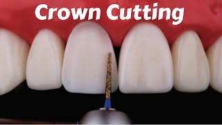 Crown Tooth Preparation Cutting for Anterior Incisor PFM Zirconia Ceramic Emax  Prostho Lecture [upl. by Karsten909]