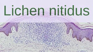 Lichen Nitidus  Pathology mini tutorials [upl. by Rosana128]