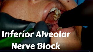 Inferior Alveolar nerve Block Injection in dentistry Landmark amp Technique in Dental Teeth Surgery [upl. by Niessuh303]