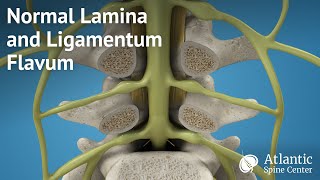 Normal Lamina and Ligamentum Flavum [upl. by Ocihc]