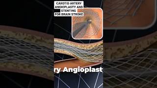 TREATMENT OF BRAIN STROKE  PREVENTION OF BRAIN STROKE  CAROTID ARTERY ANGIOPLASTY amp STENTING [upl. by Ekoorb]