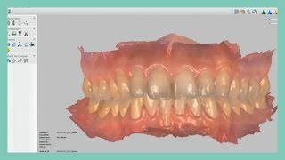 How to import STL files in Ortho Analyzer [upl. by Ahsenit668]