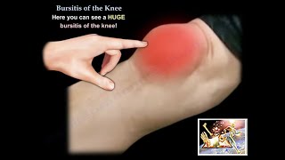 Knee Bursitis  Everything You Need To Know  Dr Nabil Ebraheim [upl. by Philipines483]