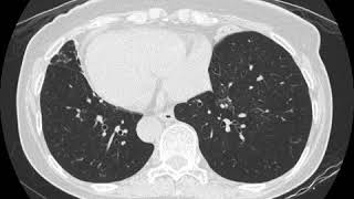 TB tree in bud Ahuja AT et al 2017 Book Essential Radiology [upl. by Colwell]