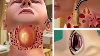 ASMR Removes foreign objects in throat amp Large pustules  Deep Cleaning Animation [upl. by Milicent]