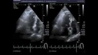 Bicycle stress echocardiography [upl. by Rog]