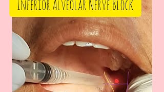 Inferior Alveolar Nerve Block is EASY [upl. by Garnette]