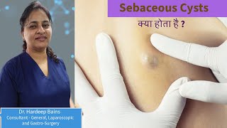 Sebaceous Cyst Removal  Surgery of Sebaceous Cyst By Dr Hardeep Bains in Delhi [upl. by Ojahtnamas]