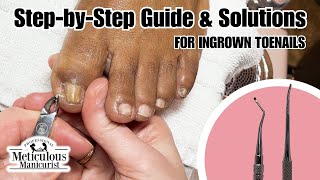 Tips For Instant Big Toe Pain Relief at Home nails satisfying [upl. by Cila]