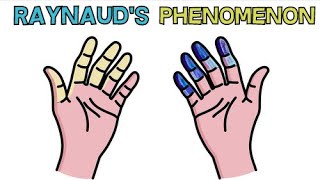 RAYNAUDS SYNDROME  CAUSE APPEARANCE DIAGNOSIS AND TREATMENT  RAYNAUDS PHENOMENON [upl. by Leanna]