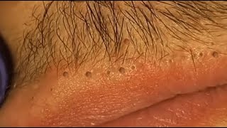 WOOW  BEAUTY OF SQUEEZE😨 BLACKHEADS REMOVAL FROM THE LIPS relaxing blackheads [upl. by Mei]