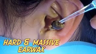 Girls Hard amp Massive Free Earwax Removal in the City [upl. by Pelage770]