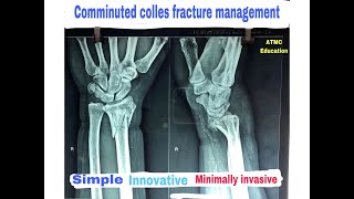 Comminuted colles fracture wrist fractureHand traumaExternal fixator [upl. by Teri]