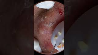 Pimple Pleaser Subscribe [upl. by Mani]