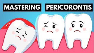 From Identifying To Management  Become An Expert On Pericoronitis [upl. by Neleag]