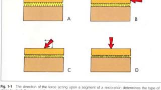 Forces Acting on Dental Restorations A Seminar [upl. by Imyaj]