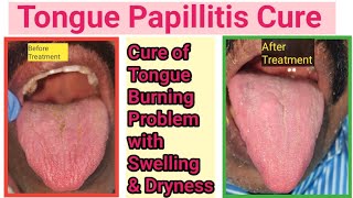 Tongue infectionGlossitis how to cure Fungal infection inside mouthTongue burning sensation cure [upl. by Cai]