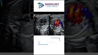 Transposition of the Great Arteries TGA DrSwapna [upl. by Eintroc]