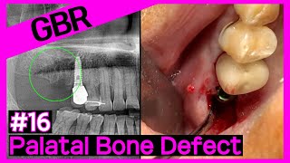 Online Surgery Placing an Implant at No16 Using OneGuide with GBR Palatal Side [upl. by Sirraj932]