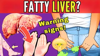 8 SIGNS THAT INDICATE LIVER FAT  EARLY SYMPTOMS OF HEPATIC STEATOSIS silent threat [upl. by Ailesor476]