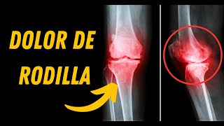 VALGO DE RODILLA  Qué es causas síntomas a quién afecta y tratamiento [upl. by Novikoff]